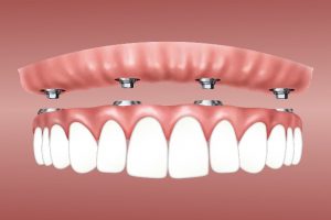 Implantologue dentaire : difficultés rencontrées et diverses solutions