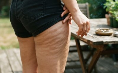Cellulite et tabac